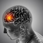 تومور سی پی انگل چیست و علل ایجاد آن کدامند؟
