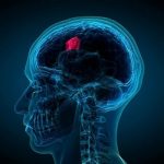 پینئوسیتوما چیست و چه علائم و عوارضی دارد؟