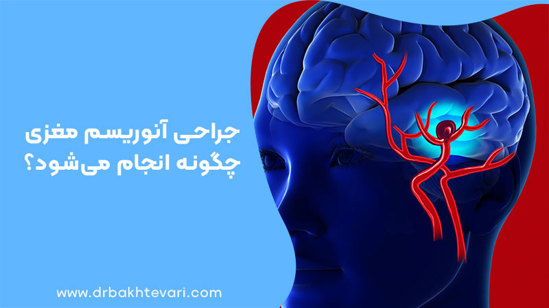 جراحی آنوریسم مغزی چگونه انجام می‌شود