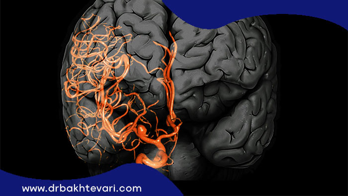 آنوریسم مغزی و محل ایجاد آن در مغز انسان