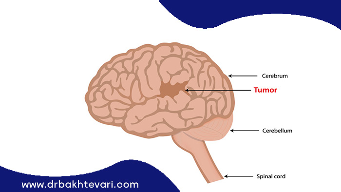 تومور مغزی دلیلی برای انجام انواع روش های جراحی قاعده جمجمه