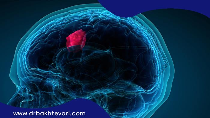 تومور مغزی بدخیم در مغز بصورت 3بعدی