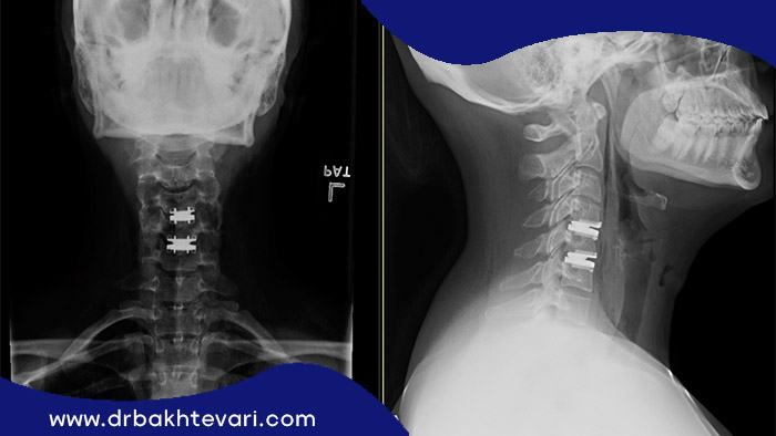 تصویر ماورای بنفش از مردی که به دیسک گردن دچار شده است