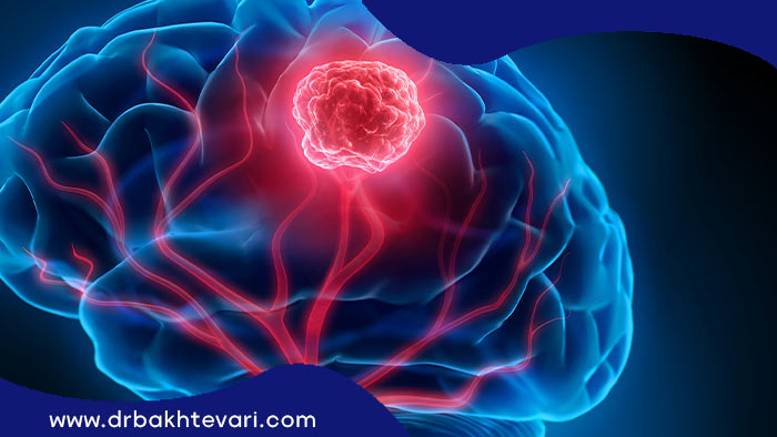 تصویری 3بعدی از یک تومور مغزیس