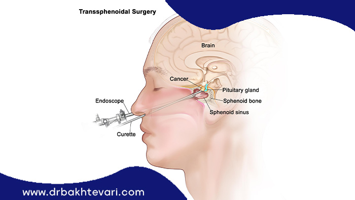روش جراحی به صورت جراحی ترانس اسفنوئیدال