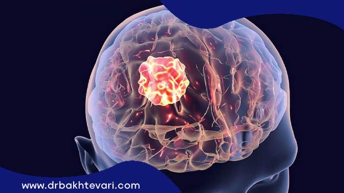 گالیوم یک نوع تومور که جراح تومور مغز آن را درمان می‌کند