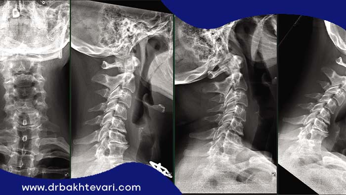 عکسی از دیسک گردن که جراح دیسک گردن در اختیار دارد
