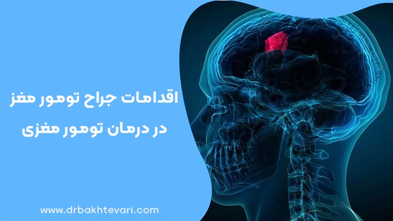 تومور مغز در سر یک بیمار
