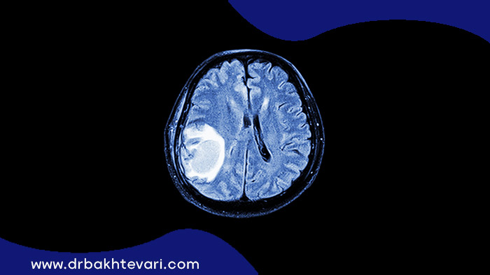 تصویر اشعه فرابنفش از توموری در داخل یک مغز