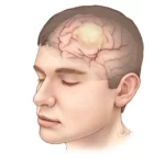 تومورهای مغزی چیست؟