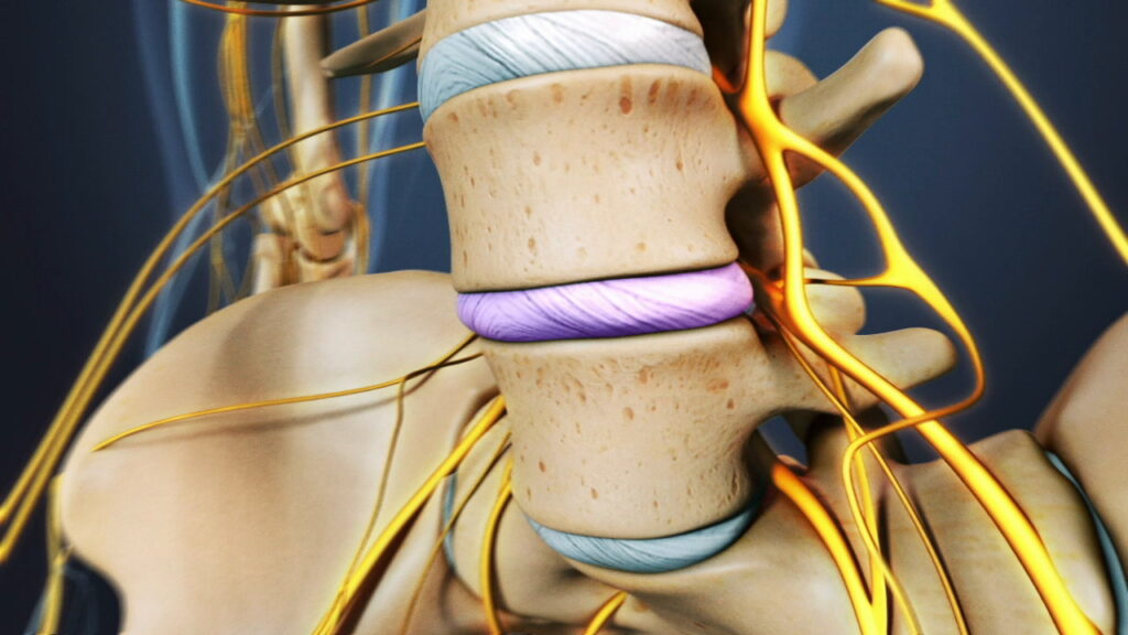 عمل فیوژن ستون فقرات +راقبت های بعد از عمل