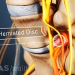 تمریناتی برای درد سیاتیک ناشی از فتق دیسک