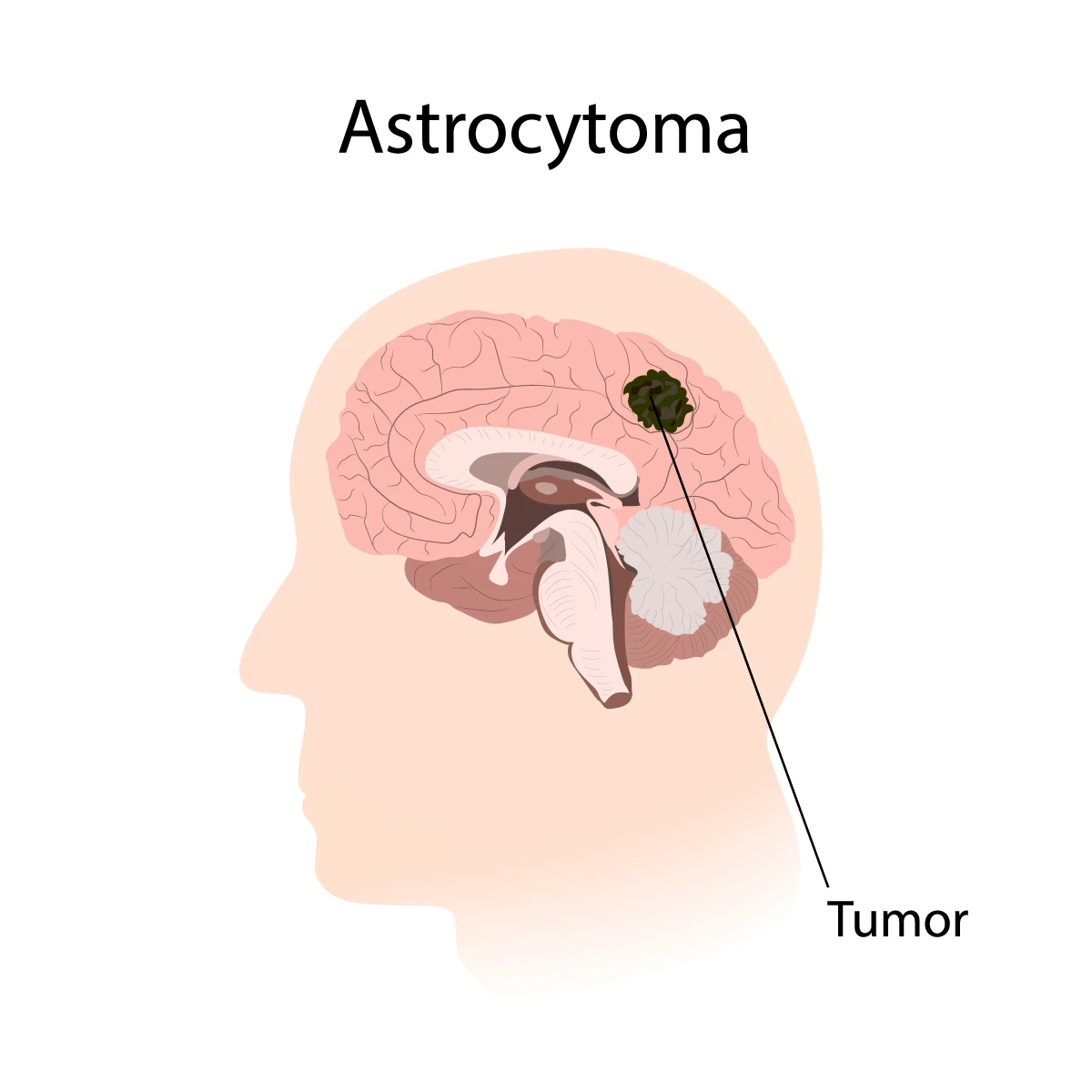تومورهای آستروسیتوما