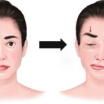 همی فاسیال اسپاسم