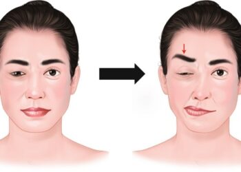 همی فاسیال اسپاسم