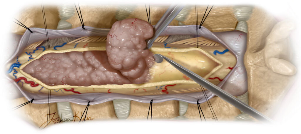 تومورهای ستون مهره و نخاع