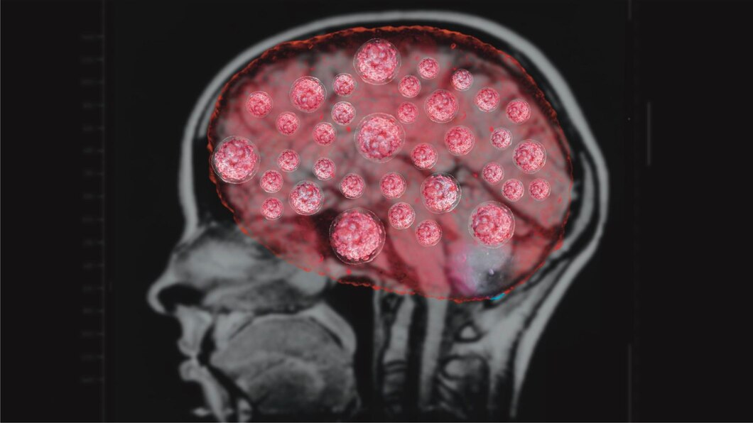 سرطان مغز، چگونه می‌توان سرطان مغز را درمان کرد؟