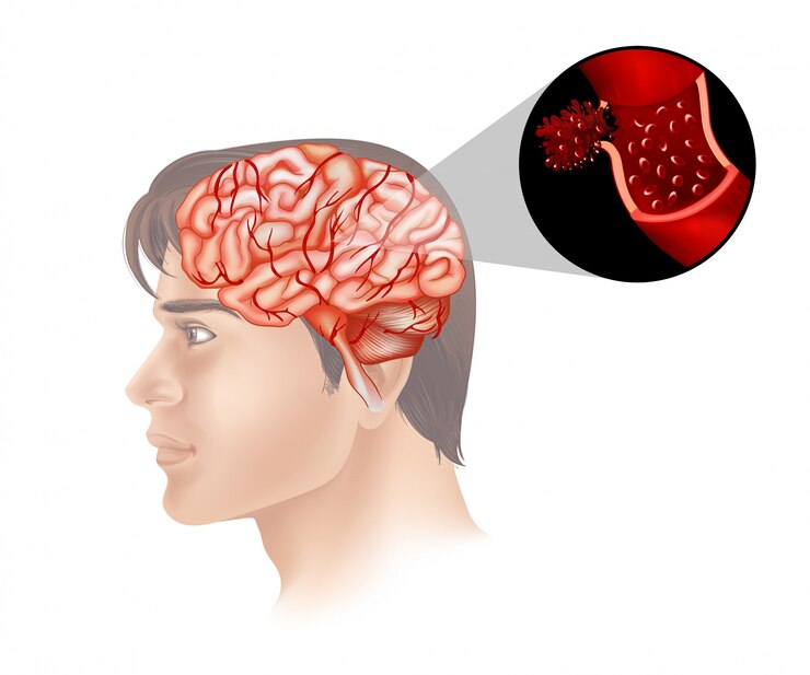 تفاوت بین میگرن و تومور مغزی در چیست - دکتر بختوری در تهراان