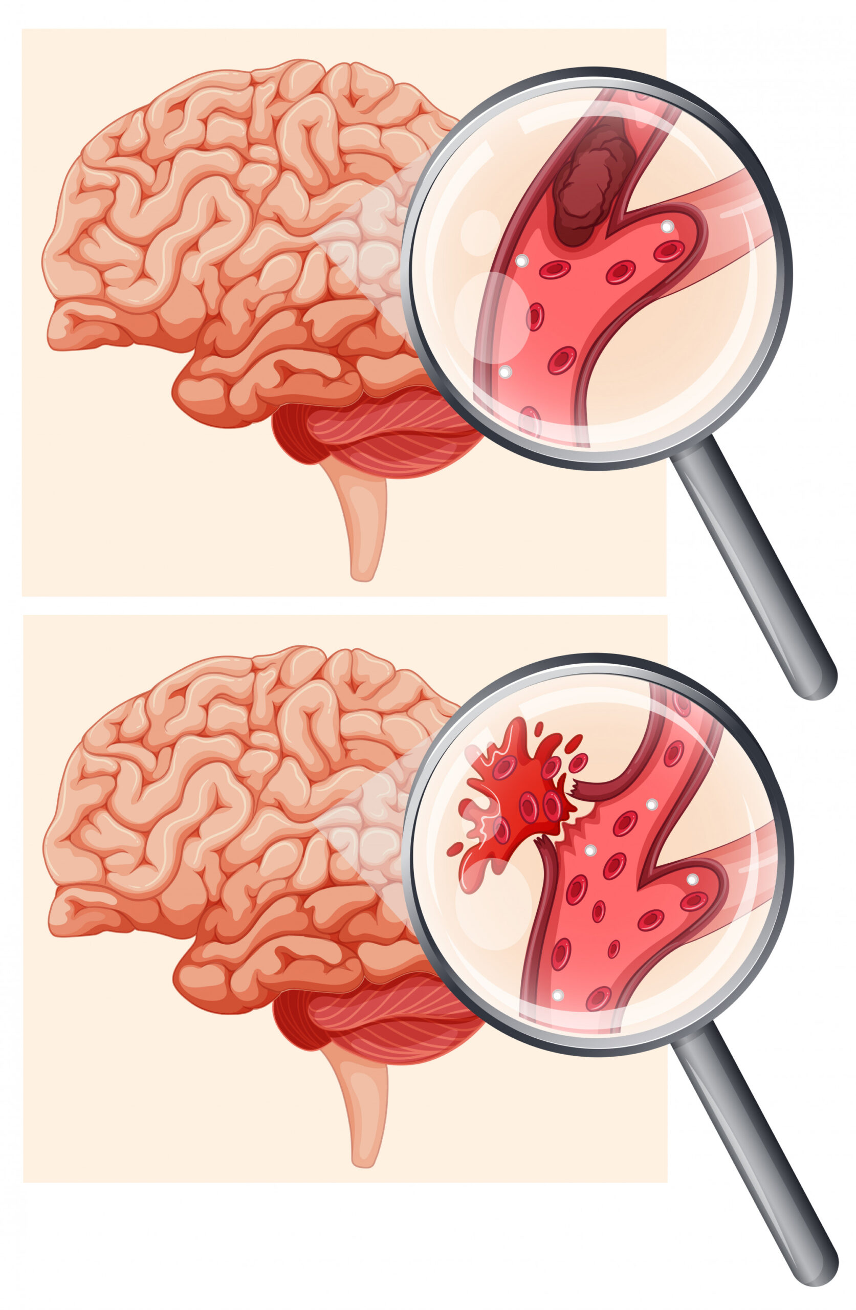 human brain hemorrhagic stroke 1308 15931 scaled دکتر مهرداد حسین زاده بختوری