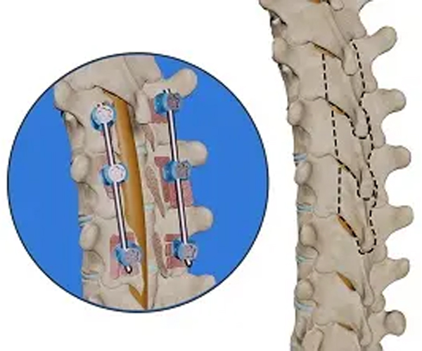 جراحی فیوژن ستون فقرات
