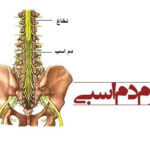 سندروم دم اسبی: علل و راه‌های درمان آن