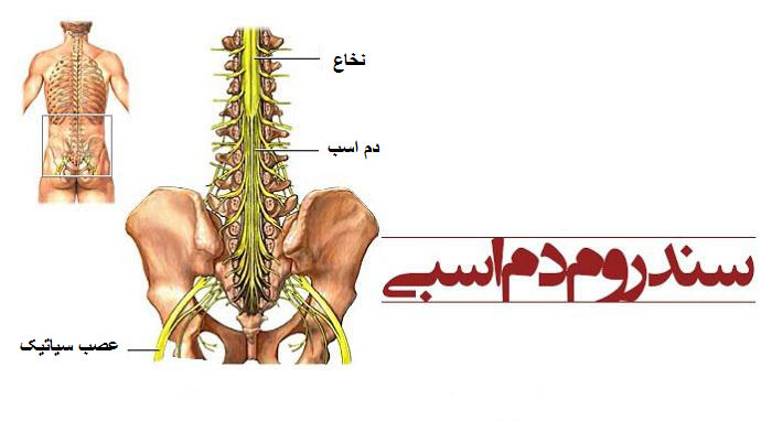 سندروم دم اسبی: علل و راه‌های درمان آن