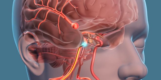 عمل جراحی آنوریسم مغزی چگونه انجام میشود؟