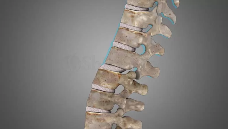اسپوندیلولیستزیس کمری چیست