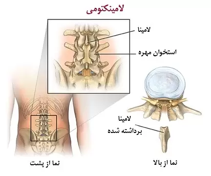 جراحی لامینکتومی: نحوه انجام و عوارض آن