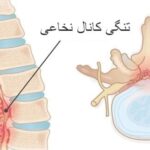 تنگی کانال نخاعی کمر و بارداری