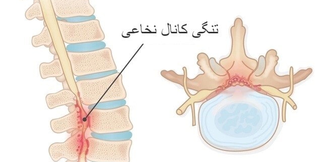 تنگی کانال نخاعی کمر و بارداری